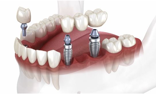 Implantes para reponer varios dientes