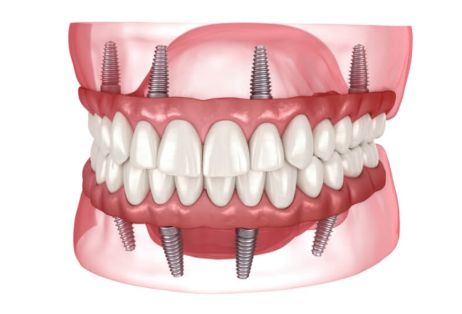 Rehabilitación completa sobre implantes